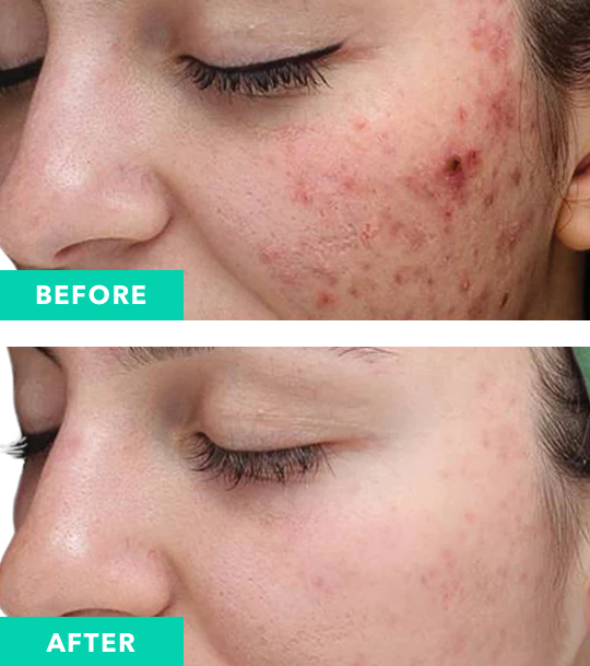 VI Peel Purify Precision Plus, Before & After