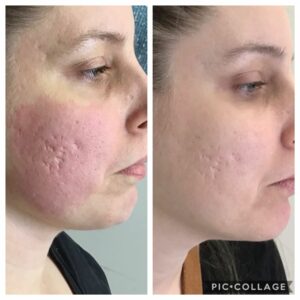 B&A #1: PDO Threading for Acne Scarring