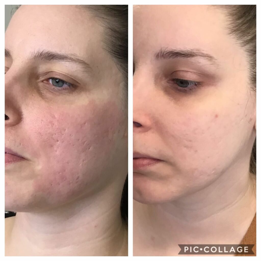 B&A #1: PDO Threading for Acne Scarring