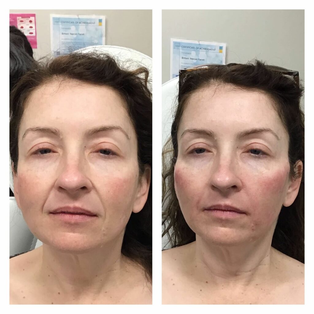 B&A #4: SaltFacial
