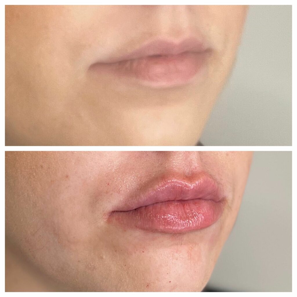 B&A #10: RHA 3 Lip Filler