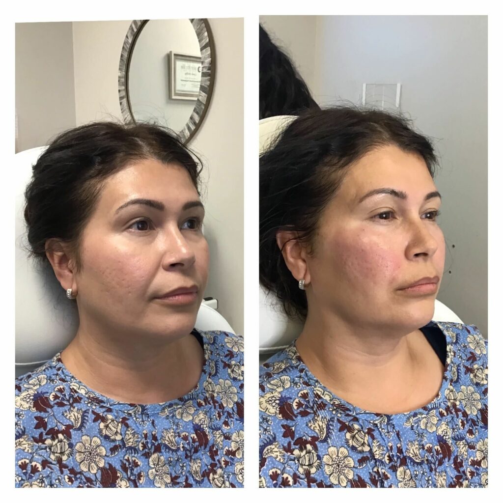 B&A 17: Nasal Labial Thread Lift