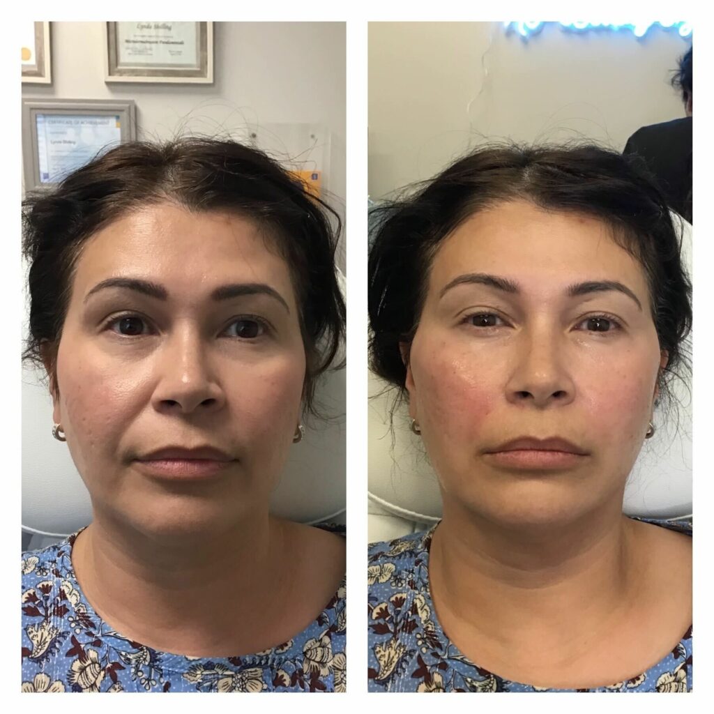 B&A 17: Nasal Labial Thread Lift